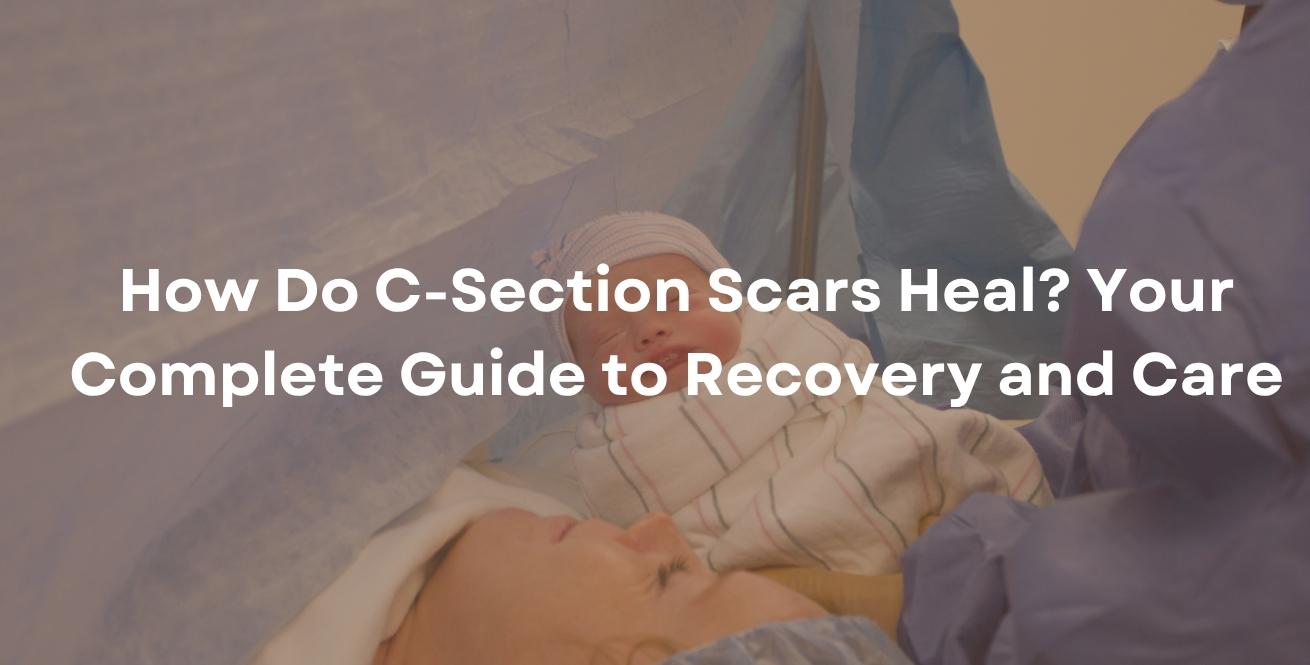What Should You Know About C-Section Scars Healing?