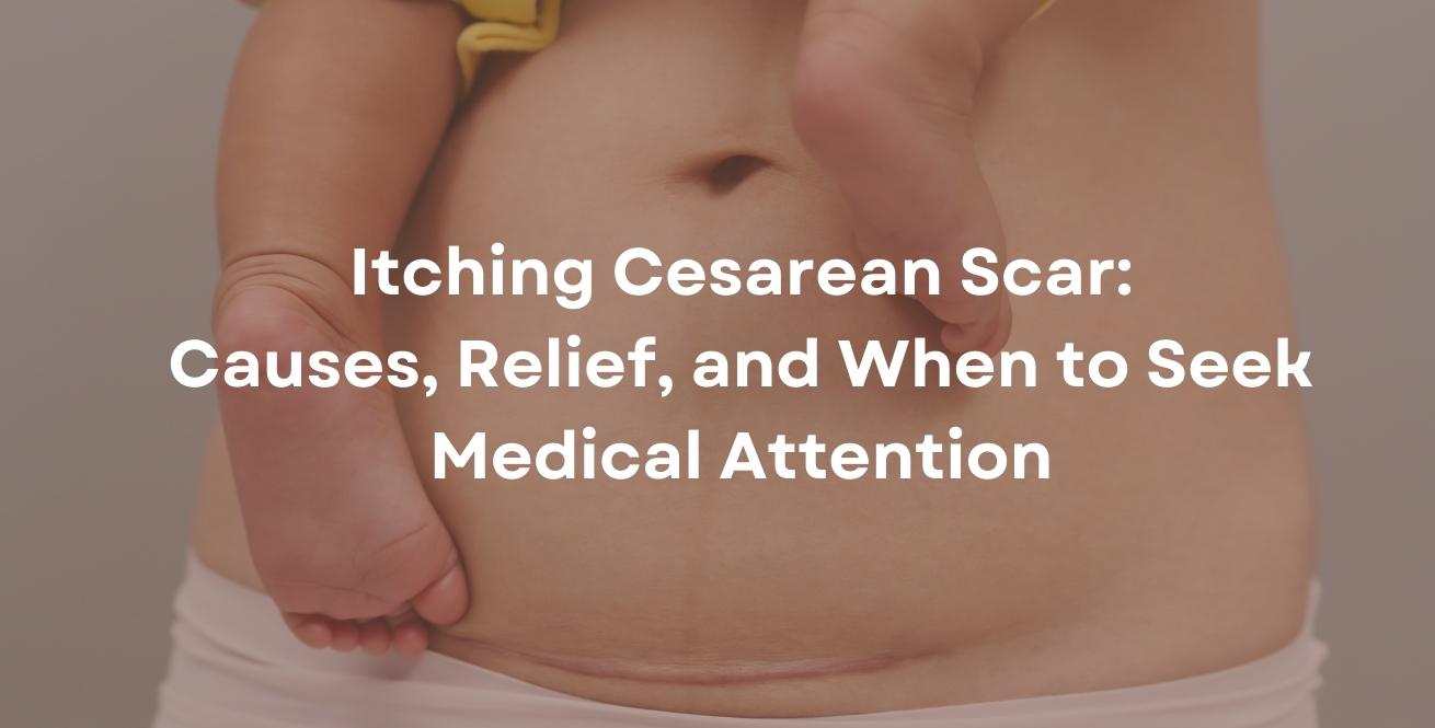 Itching Cesarean Scar: Causes, Relief, and When to Seek Medical Attention
